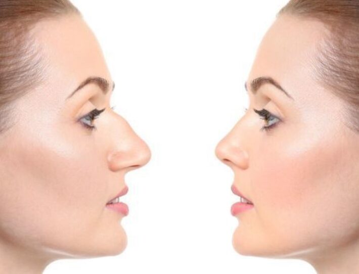 rhinoplasty
